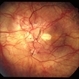 High Myopia High Myopia